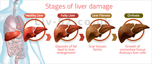 Liv 52 : reviews, dosage, benefits in fatty liver, liver care in  bodybuilding